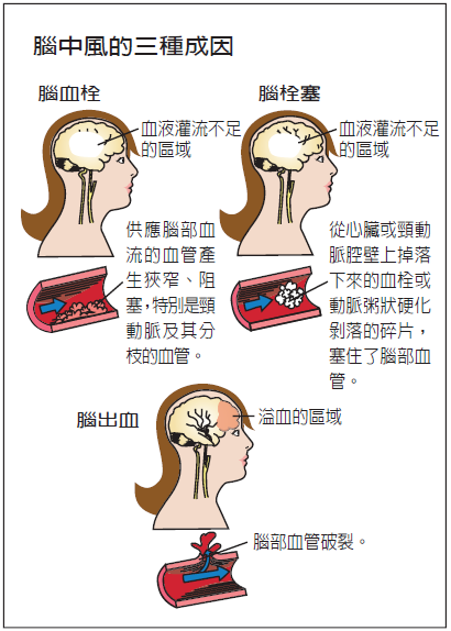 腦中風的三種原因