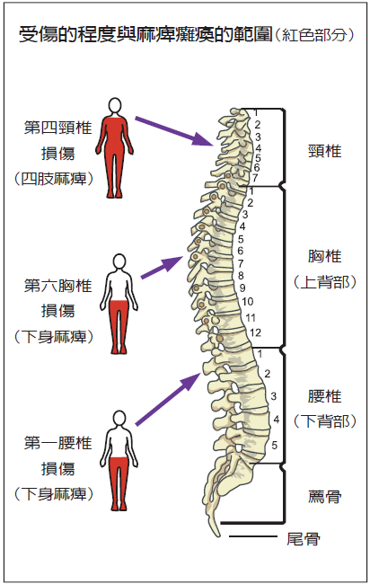 脊椎與脊髓創傷